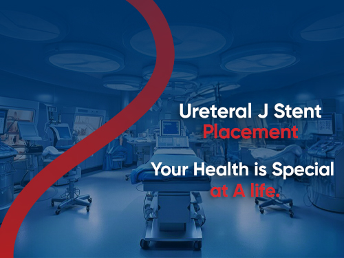 Ureteral J Stent Placement
